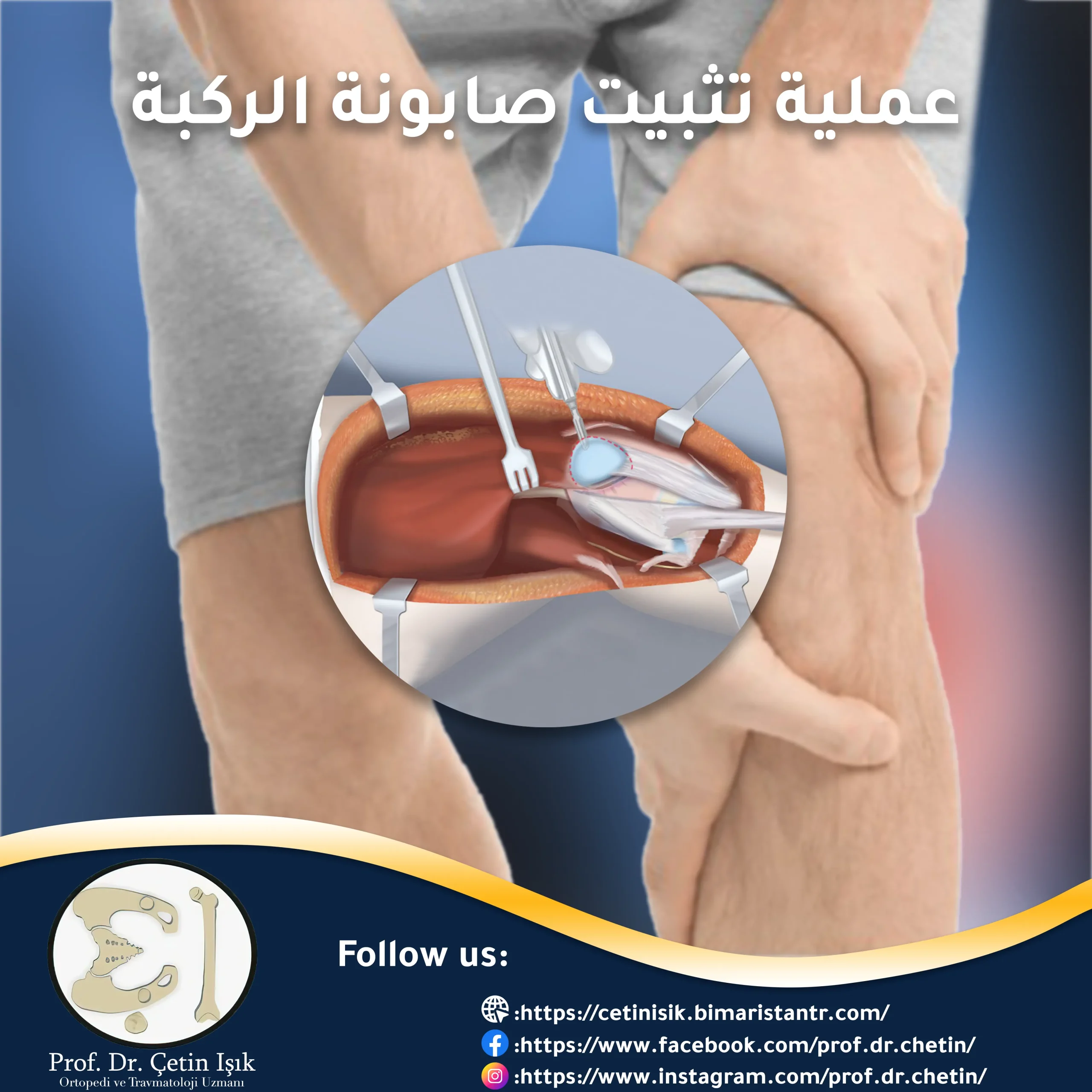 Learn about the kneecap stabilisation surgery