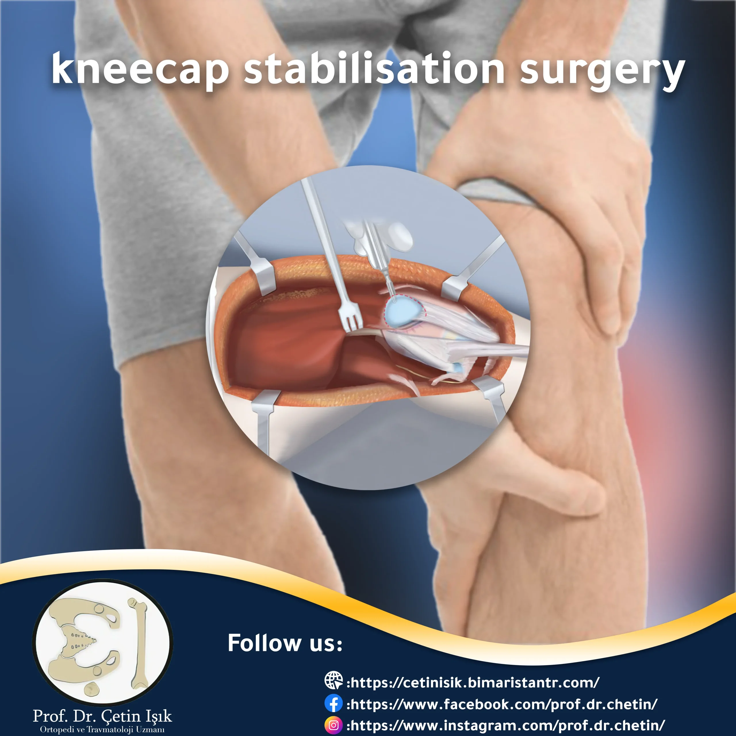 Cover image of the kneecap stabilisation surgery article