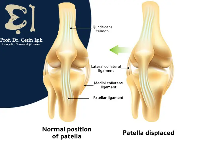 An image showing a comparison between the normal kneecap position and the dislocated kneecap