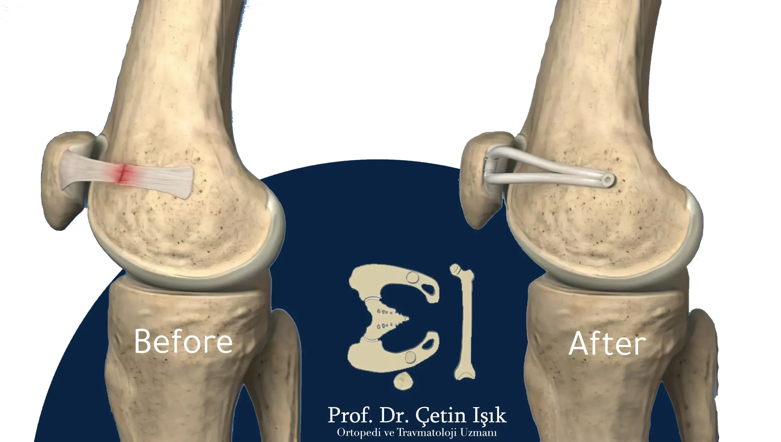 Image showing the implantation of a new medial patellofemoral ligament to replace the old torn ligament that caused the dislocation of the kneecap.