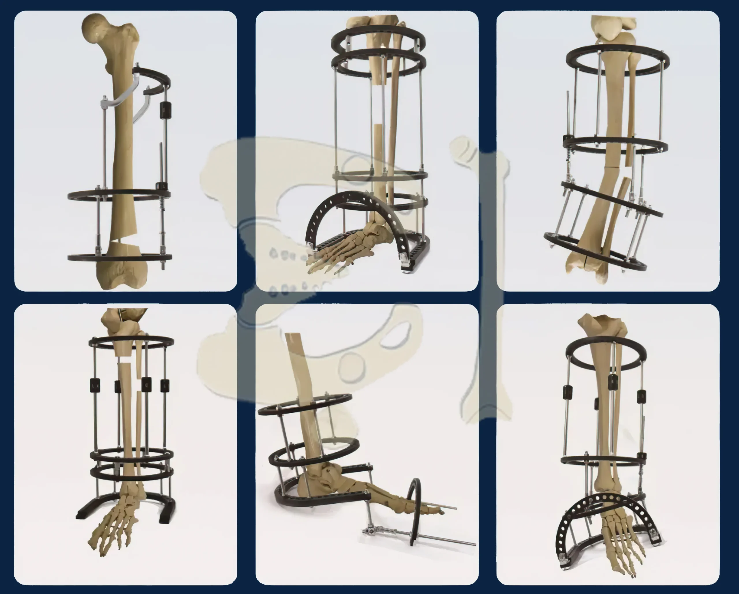 From the picture, we can see the shape of the Ilizarov device and how it is fixed for different bone fractures