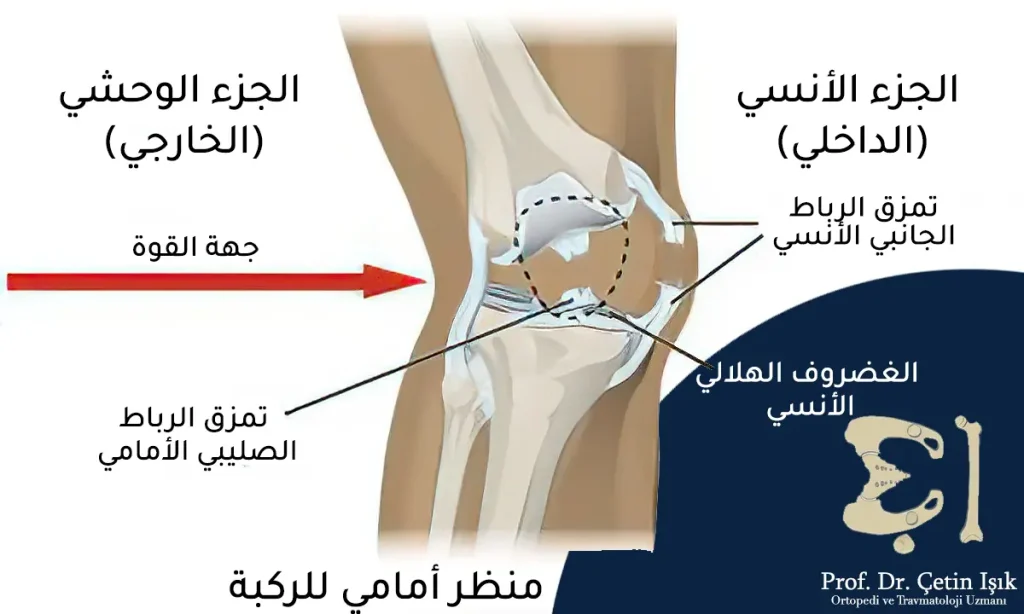 صورة توضح الإجهاد الأروح وجهة القوة التي تؤدي إلى حدوث تمزق في الرباط الجانبي الأنسي للركبة إضافة إلى الرباط الصليبي الأمامي