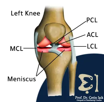 Image showing the ligaments of the left knee, which are the medial (inner) collateral ligament, the lateral (outer) collateral ligament, the anterior cruciate ligament, and the posterior cruciate ligament, in addition to the meniscus of the knee