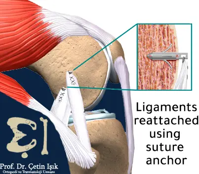 Image showing retightening of the ligaments with stitches.