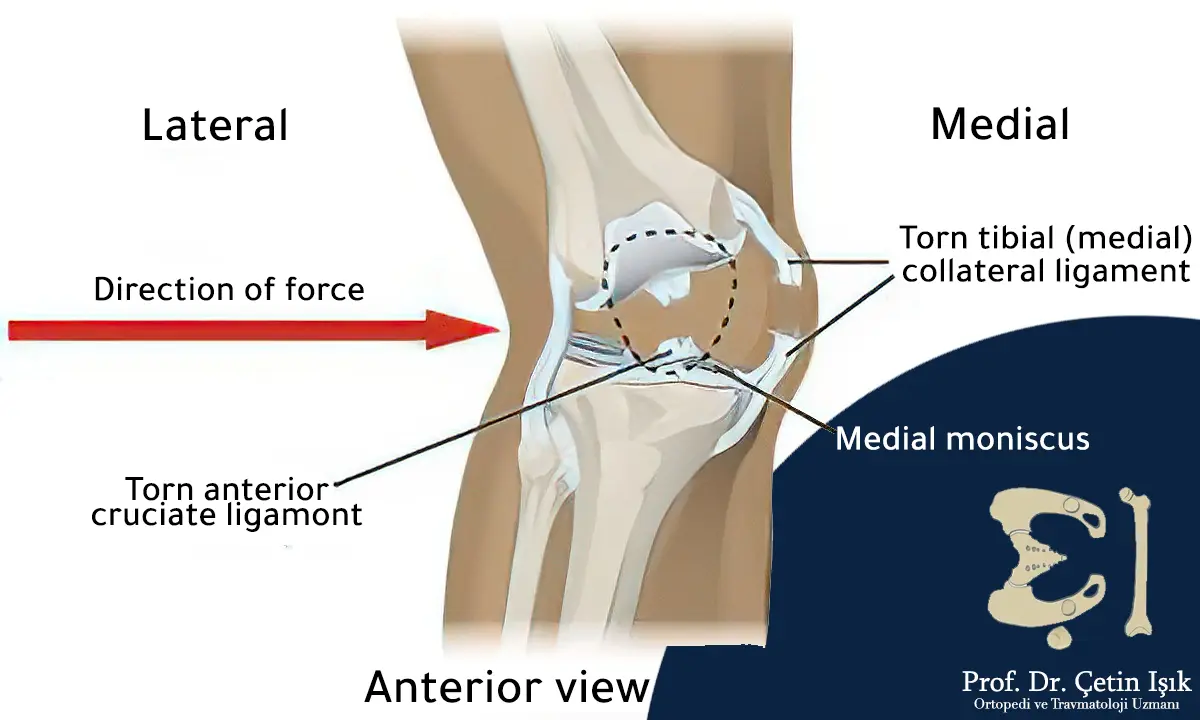 Image showing valgus stress and the direction of force that leads to tearing of the medial collateral ligament of the knee in addition to the anterior cruciate ligament