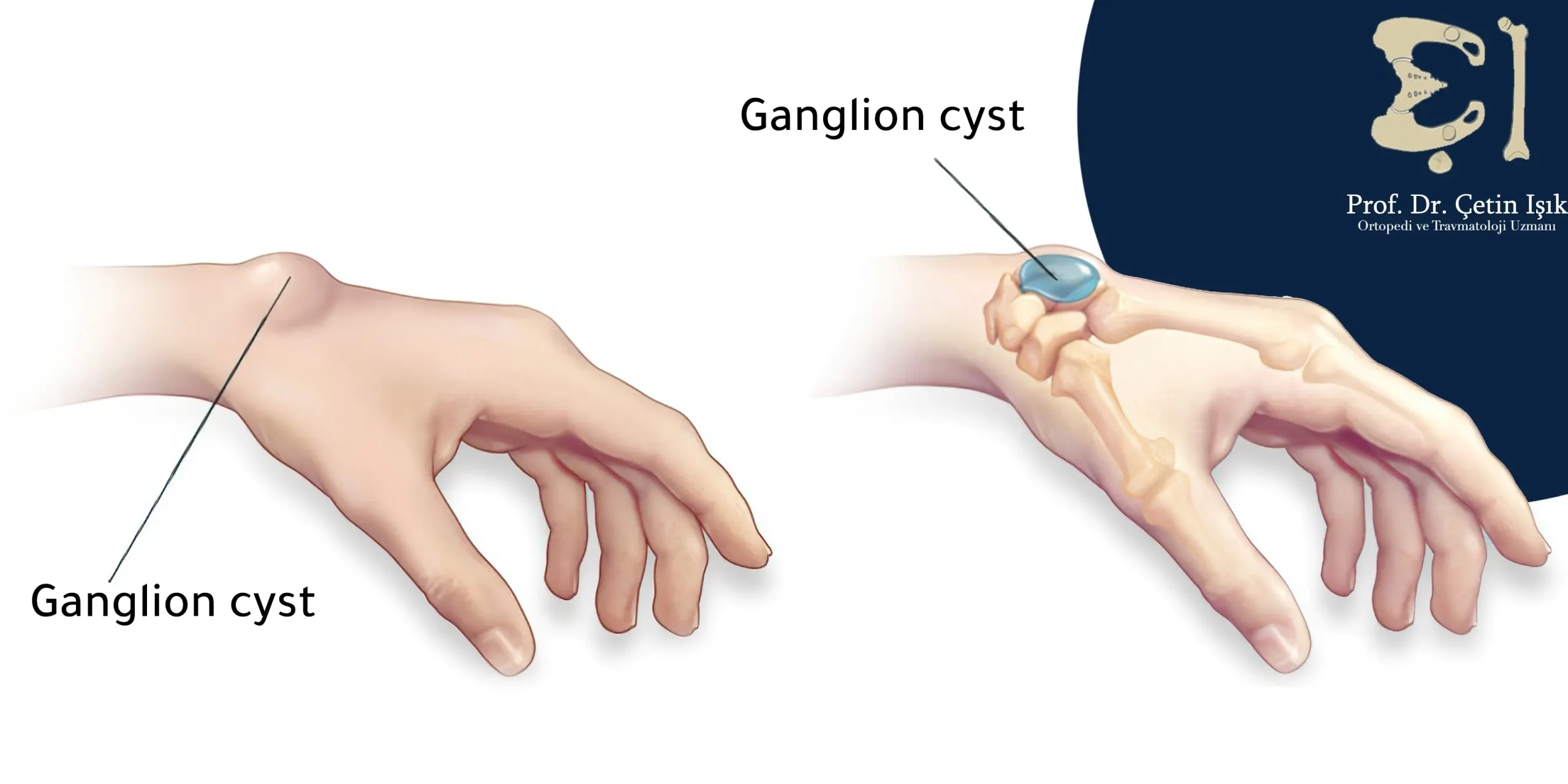 An image showing the ganglion cyst that appears in the same place as the wrist bone protrusion and with the same shape and is differentiated from the protrusion by palpation, as the cyst is soft