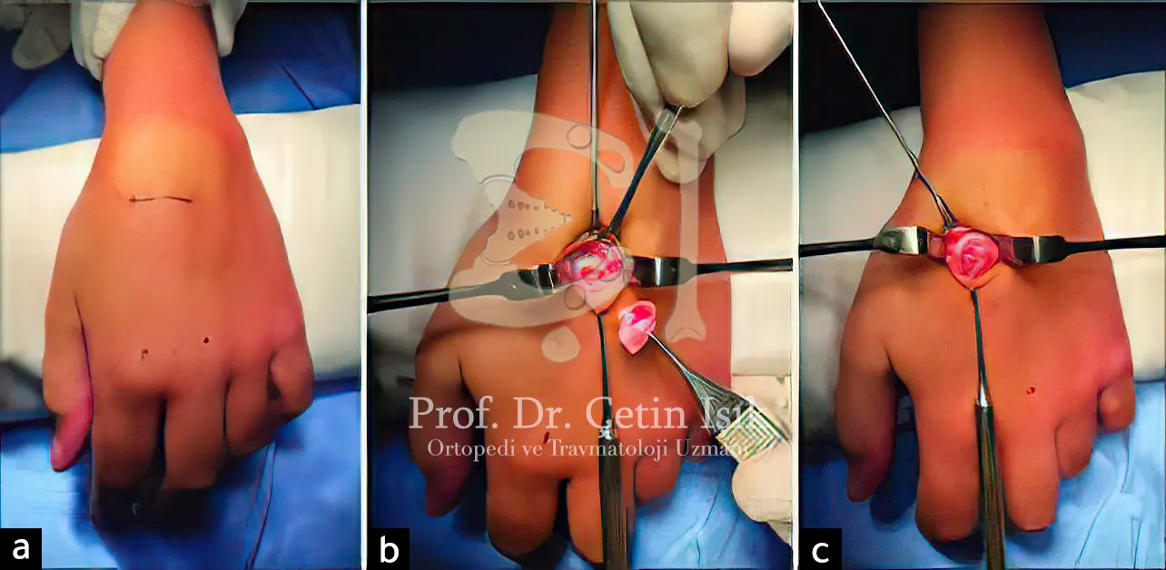 An image showing the surgical work that is performed to remove the protrusion, where a transverse incision is made at the base of the metatarsal, and the protrusion is removed using surgical tools