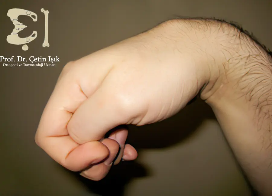 An image showing a wrist knuckle is a carpal boss