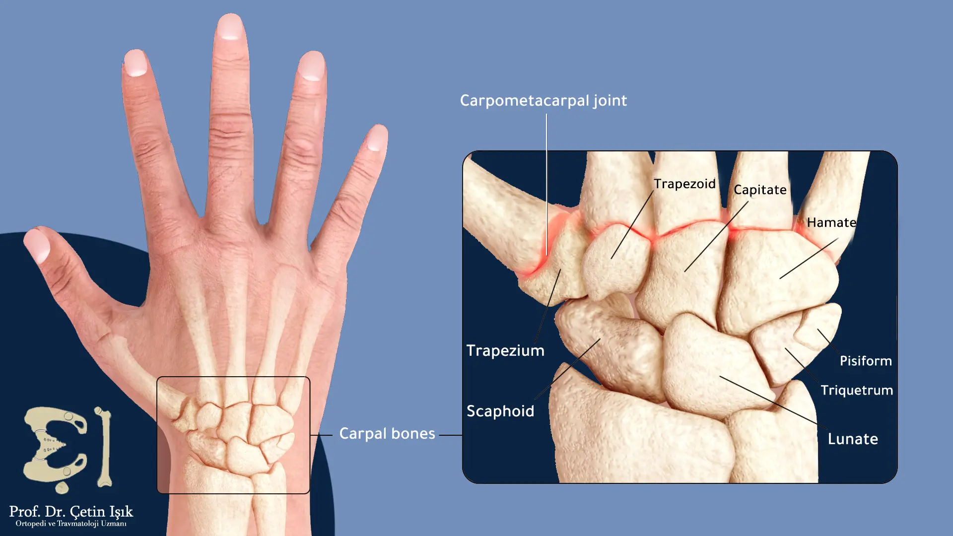 An image showing the carpal bones and the carpal joint between the carpal and metacarpal bones