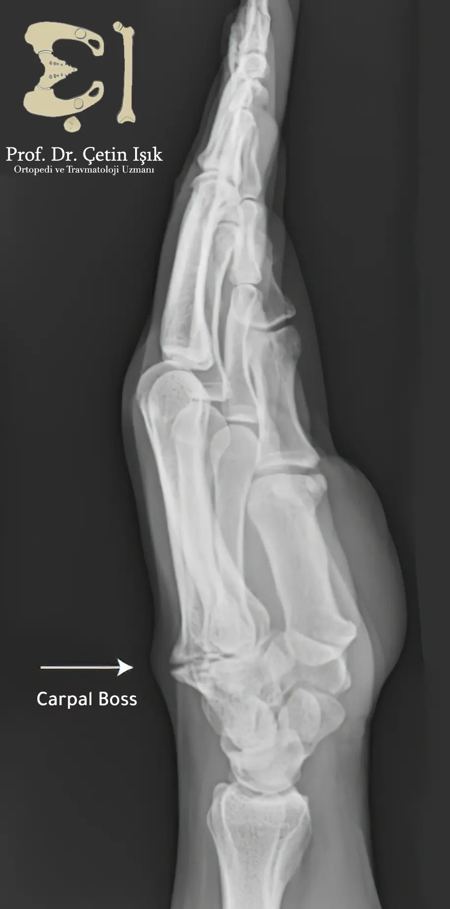 An image showing carpal boss by radiography, through X-Ray