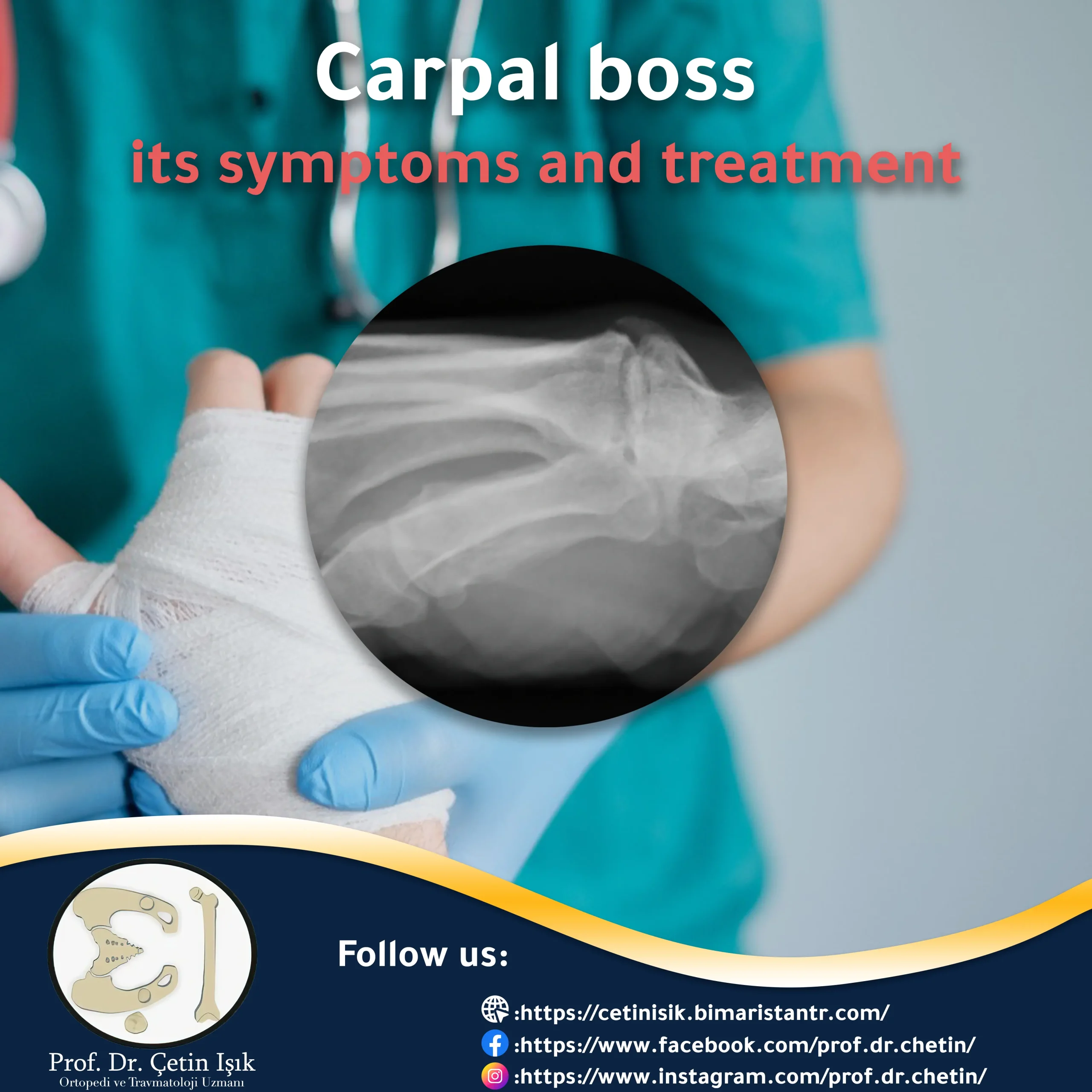 Carpal boss; Is it a serious problem?