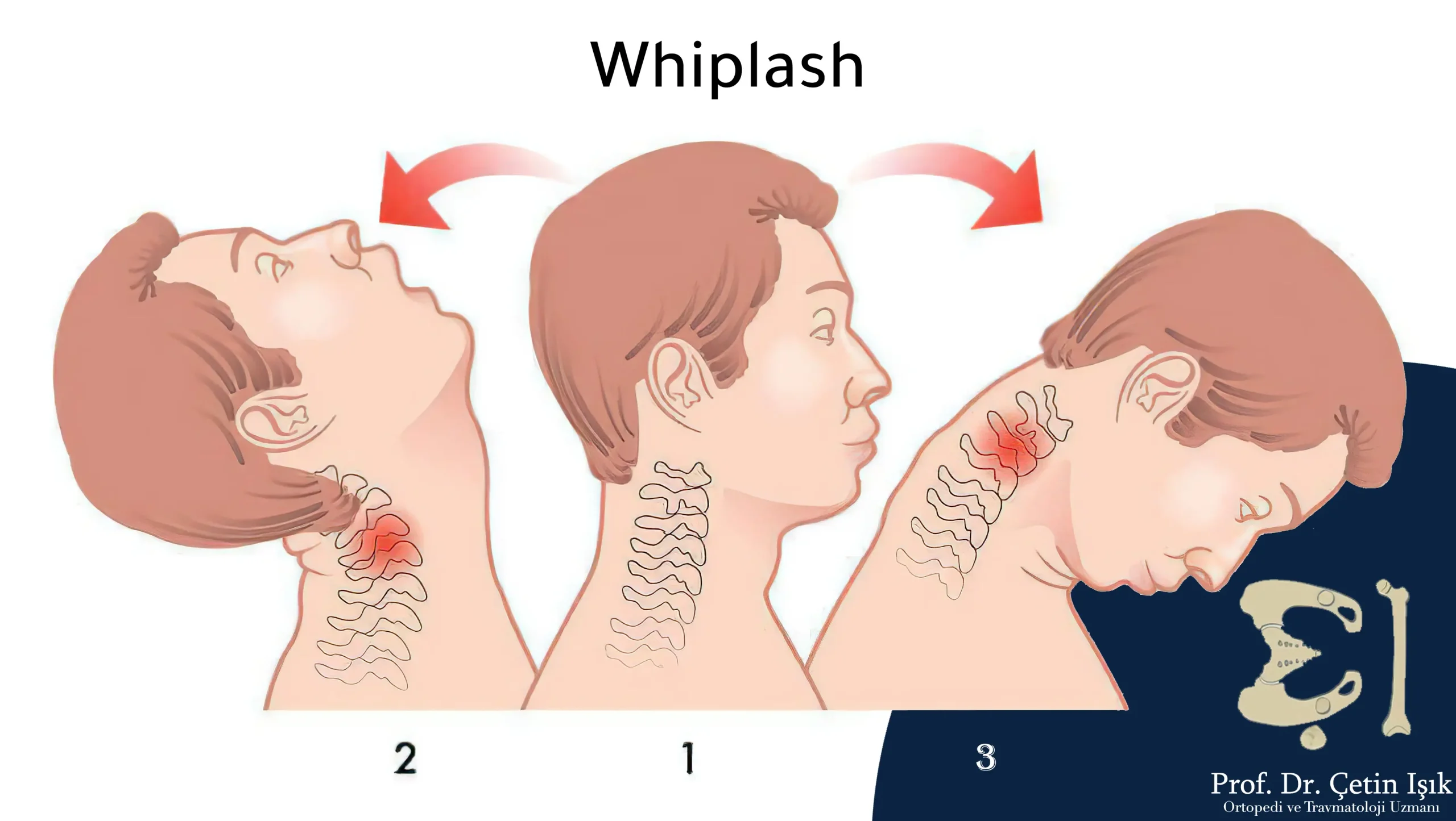 Image showing whiplash (rapid and sudden movement between hyperflexion and hyperextension) leading to neck twisting