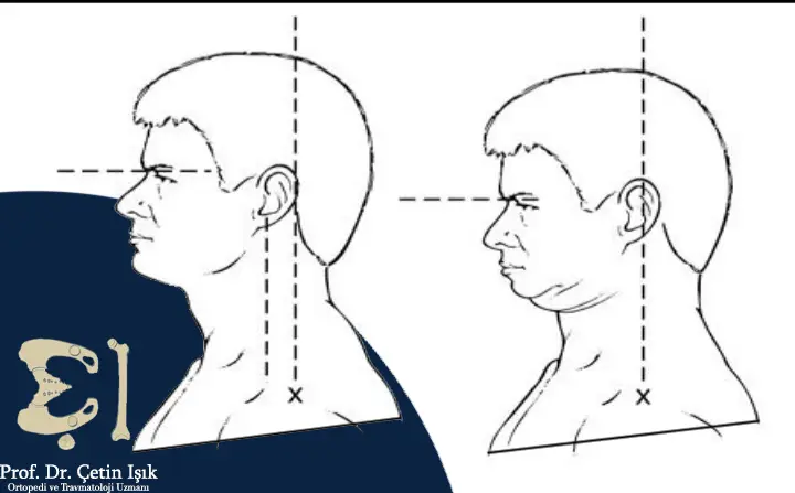 Image showing how to perform the pivot extension exercise, where the patient gently bends his chin and moves his head back while keeping the eyes level straight forward