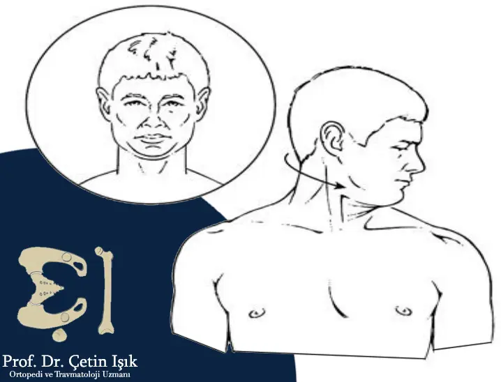Image showing how to perform a rotation exercise where the patient rotates his head and looks over his shoulder while keeping his head straight