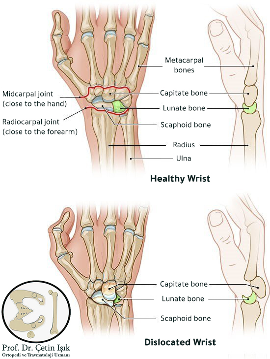 An image showing the anatomical components of the hand, including the phalanges at the top, the metatarsal bones, and the wrist
