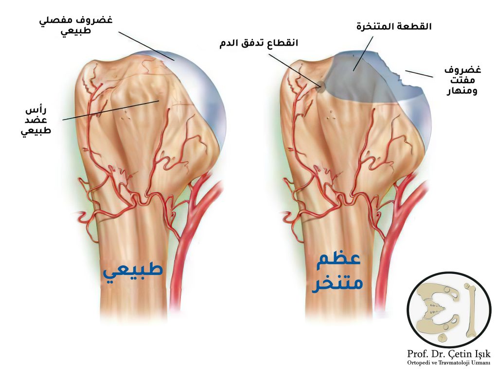 صورة توضح الفرق بين العظم الطبيعي (رأس وغضروف مفصلي طبيعيين) والعظم المتنخر (قطعة متنخرة وغضروف مفصلي مفتت)
