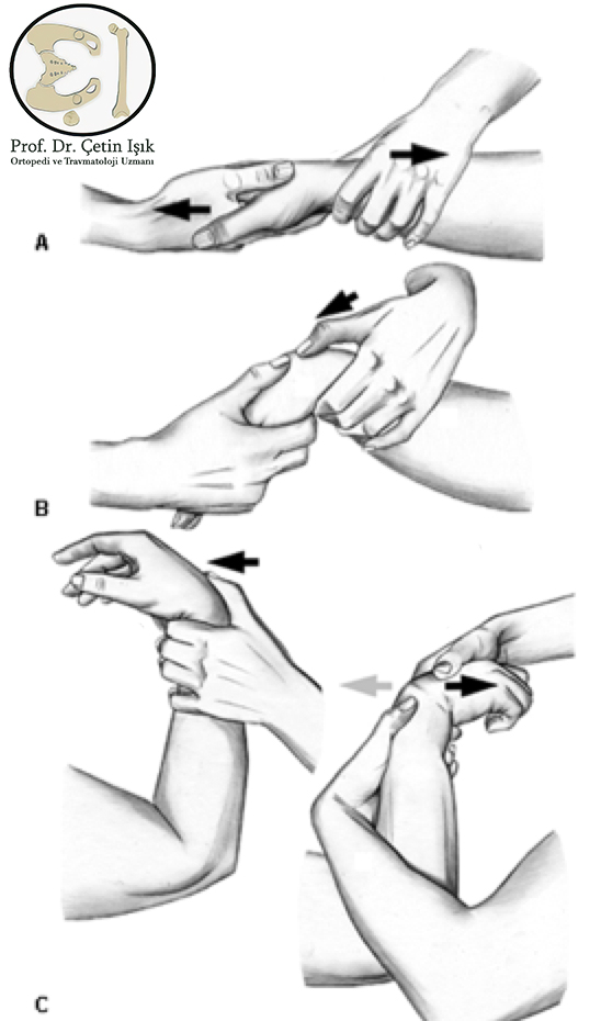 Image illustrating the response to dislocation of the hand joint through manual maneuvers of stretching and rotation