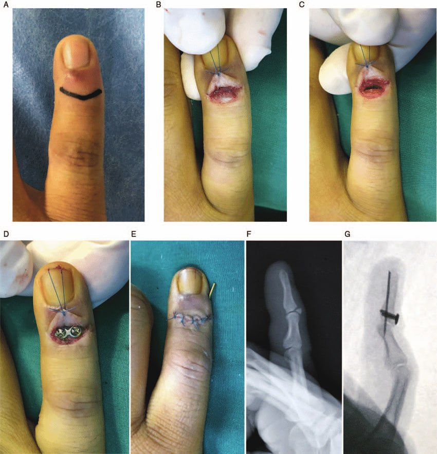 The process of breaking a finger, which begins with opening the skin, accessing the broken finger, and placing a screw to fix the fracture in the finger