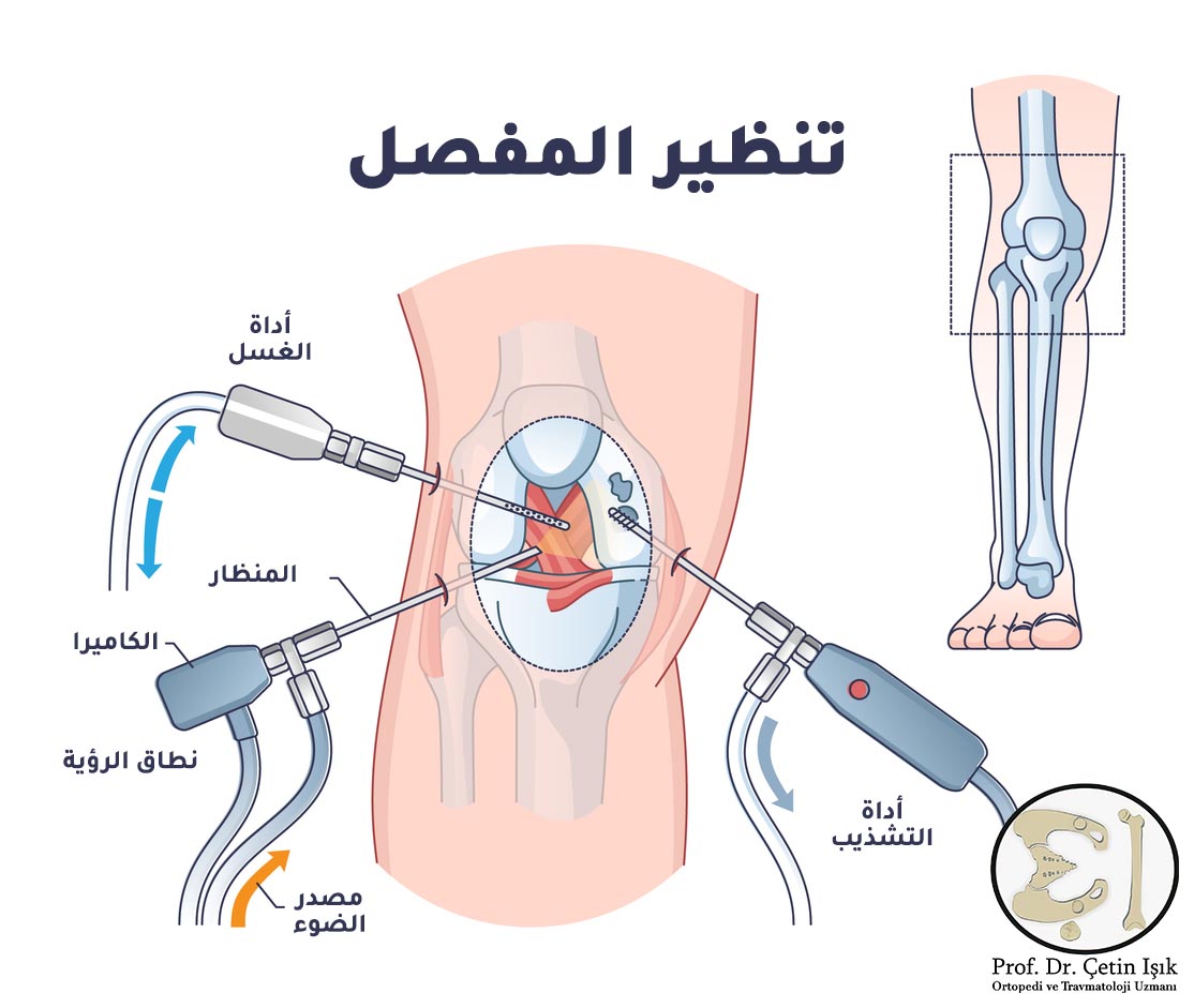 Knee arthroscopy procedure and tools used in arthroscopy