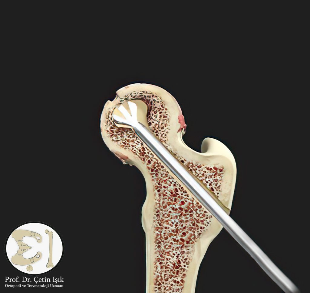 صورة توضح عملية تخفيف الضغط في العظم، حيث يتم إزالة جزء من الطبقة الداخلية للعظم مما يؤدي إلى تخفيف الضغط وإنتاج أنسجة وأوعية جديدة.