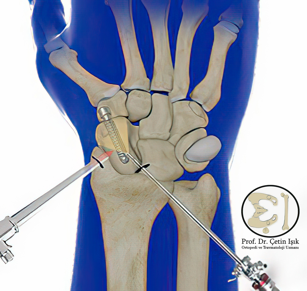 Image showing arthroscopic fixation of dislocated wrist bones