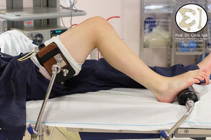 صورة توضح وضعية المريض أثناء تنظير الركبة والجهاز الذي يوضع حول الفخذ لتثبيت الركبة أثناء التنظير