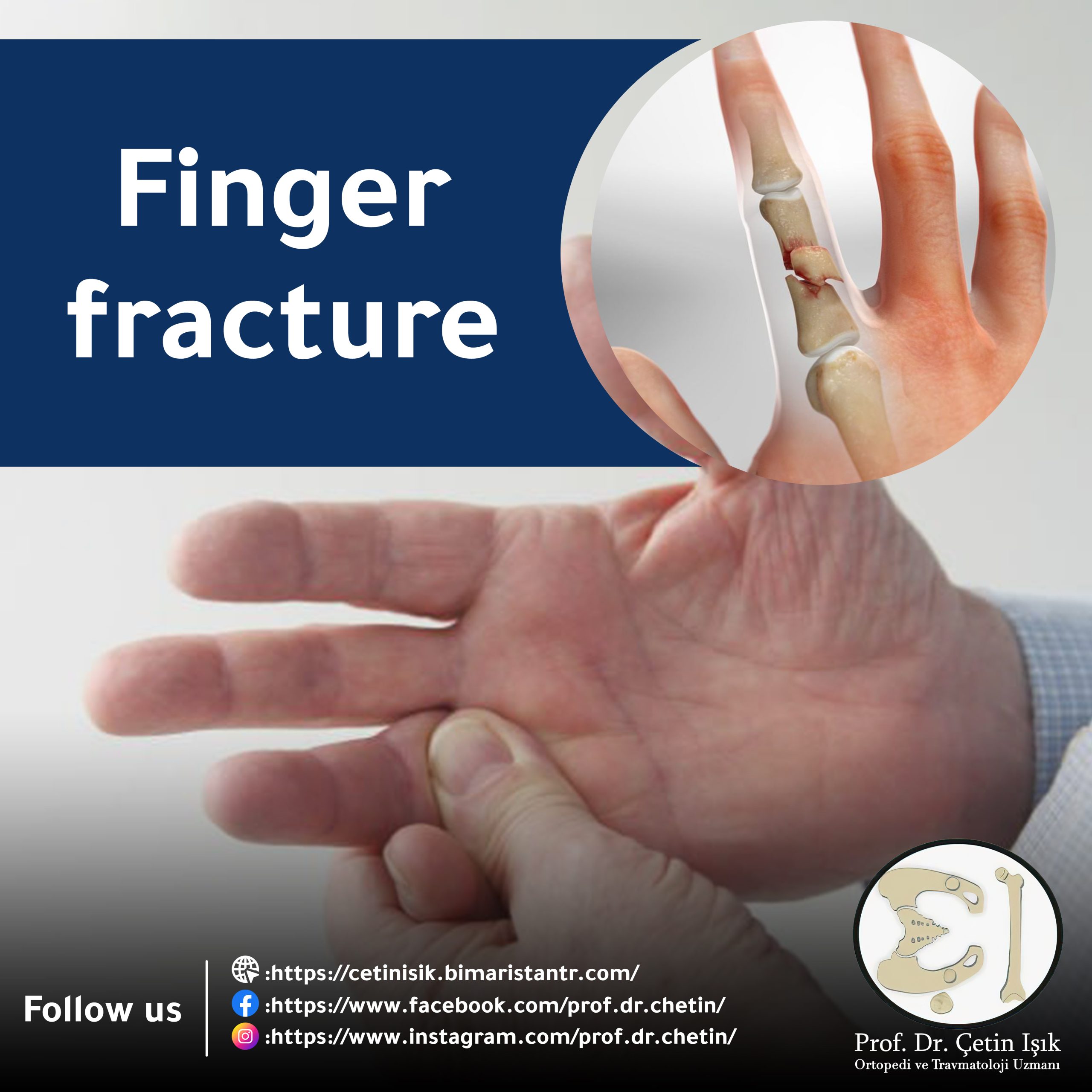 Cover image of a broken finger article
