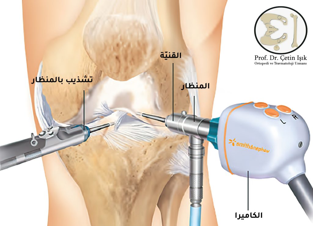 Knee arthroscopy using an endoscope that contains a camera and cannula, in addition to a trimmer to clarify the view