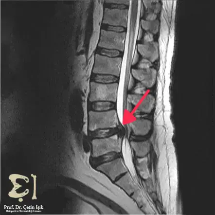 An MRI shows a herniated disc that may be pressing on the sciatic nerve, leading to inflammation