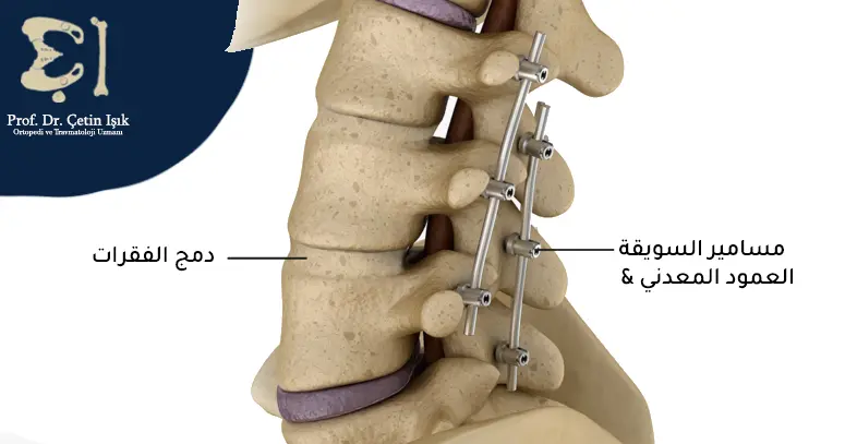How to perform spinal fusion using screws and a metal column to stabilize the spine