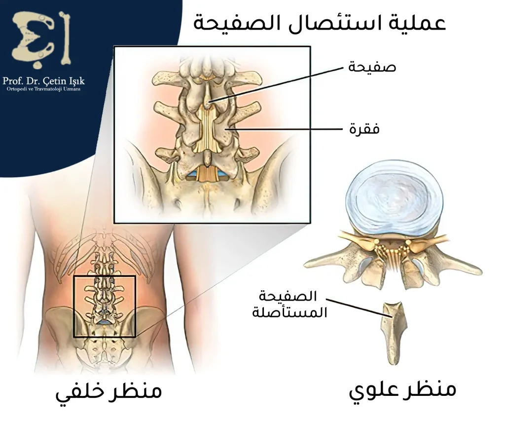 Laminectomy method to expand the spinal canal and relieve pressure on the nerves