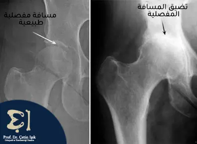 A simple radiograph of hip arthritis showing narrowing of the joint space as a result of inflammation compared to a normal joint space in a healthy hip joint