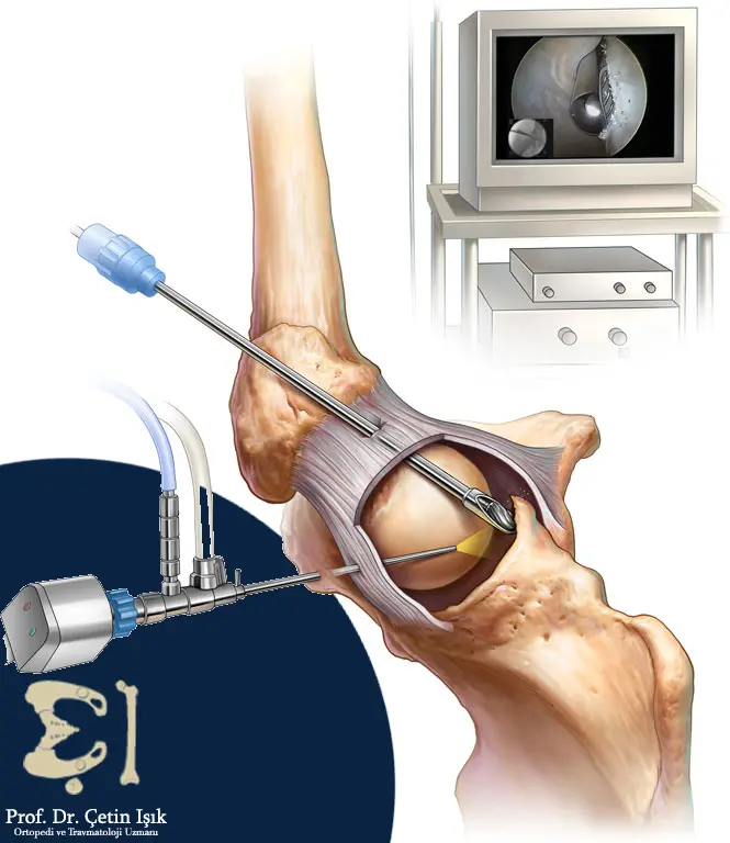 Treating hip arthritis through arthroscopic hip operations using special tools inserted through small holes