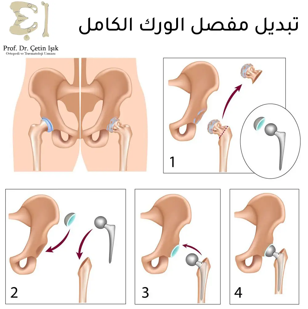 The method of total hip replacement involves removing the hip joint, placing the artificial socket and head, and implanting the metal column inside the femur