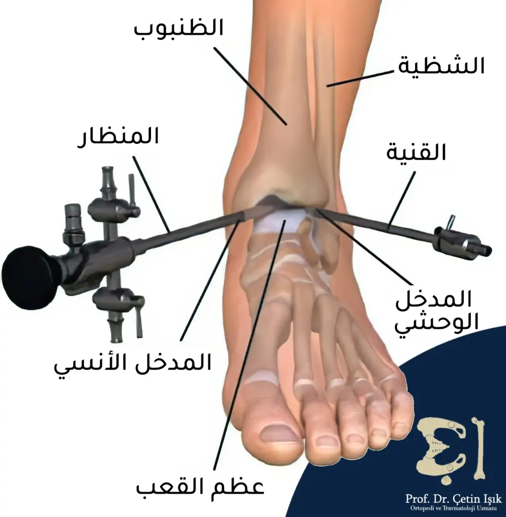 How to perform ankle arthroscopy by inserting special tools, namely an endoscope with a small camera and a cannula, through two entrances, in order to view the skeletal structures inside the joint and remove the damaged parts.