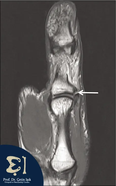 An MRI image showing a ligament tear
