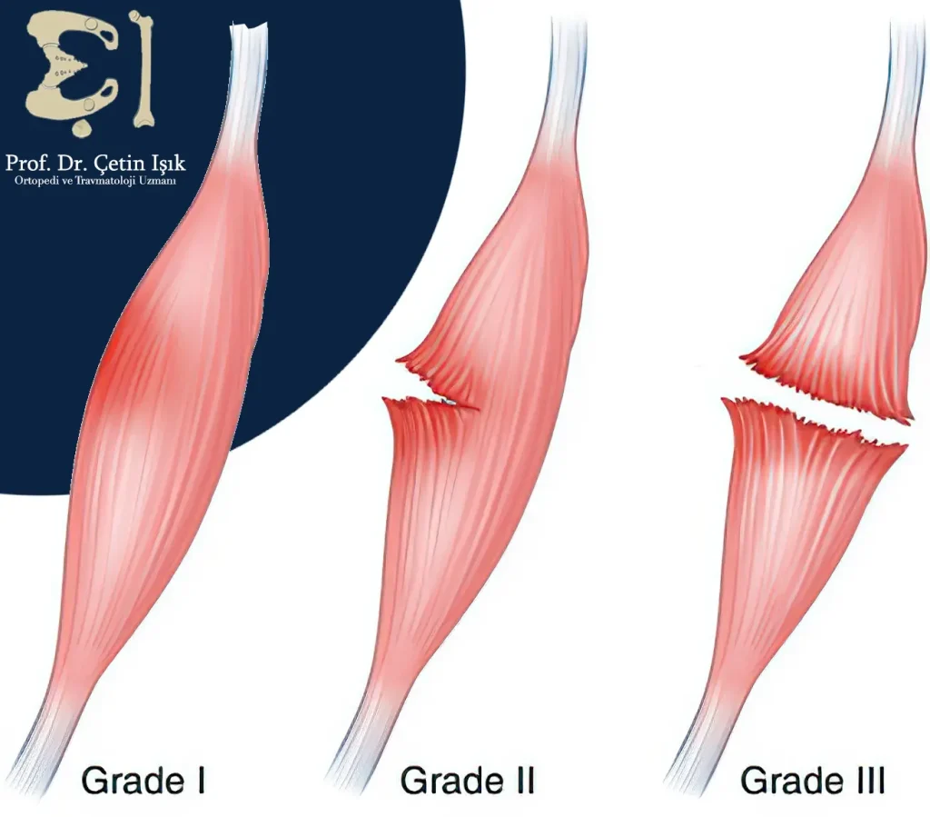 Degrees of muscle tear: There are three degrees: the first is a slight tear in the muscle fibers, the second is a moderate, partial tear of the fibers, and the third is a severe and complete tear of the muscle fibers.