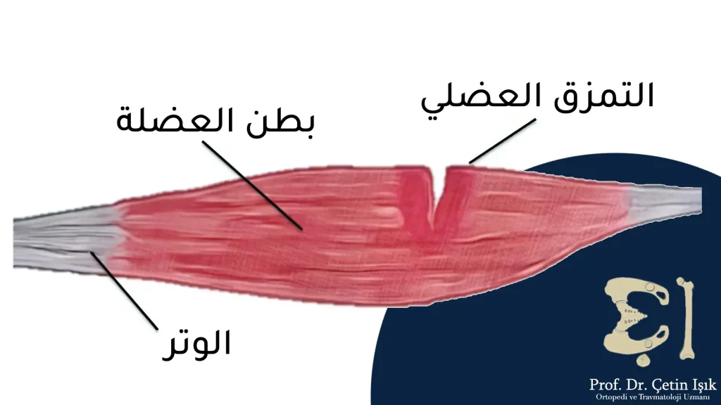 A muscle tear occurs in the muscle, which consists of the muscle belly and the tendon that connects it to the bone