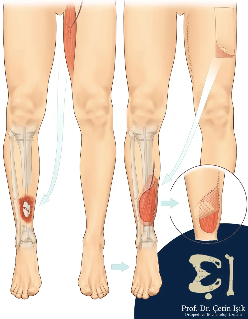 طريقة إجراء زرع الطعوم العضلية، حيث تم أخذ طعم عضلي من الفخذ ووضعه مكان العضلة الممزقة في الساق