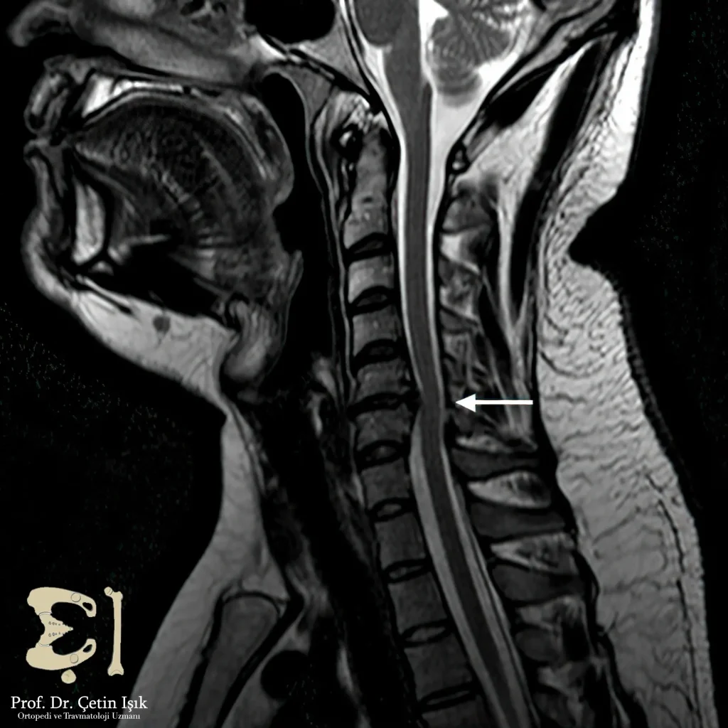 An MRI of a herniated cervical disc and its pressure on the nerves