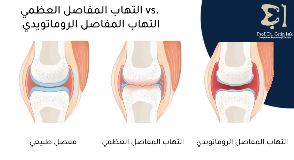 The difference between a normal knee joint and a knee joint affected by osteoarthritis (we notice erosion of the joint cartilage) and a joint affected by rheumatoid arthritis (we notice damage to the synovial membrane, thickening, and increased fluid in it)