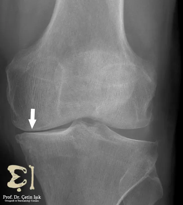 Joint space narrowing caused by osteoarthritis