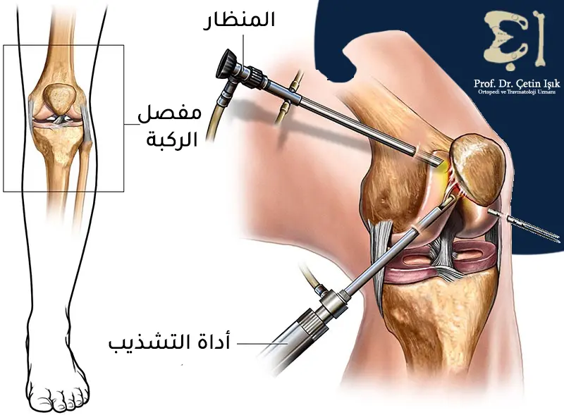 Knee arthroscopy method to treat knee stiffness by inserting an scope and a trimmer (shearing) through small holes to diagnose and treat various knee injuries. 