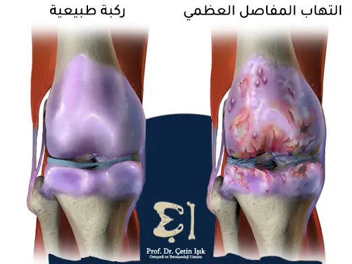 The difference between a normal knee and a knee affected by osteoarthritis