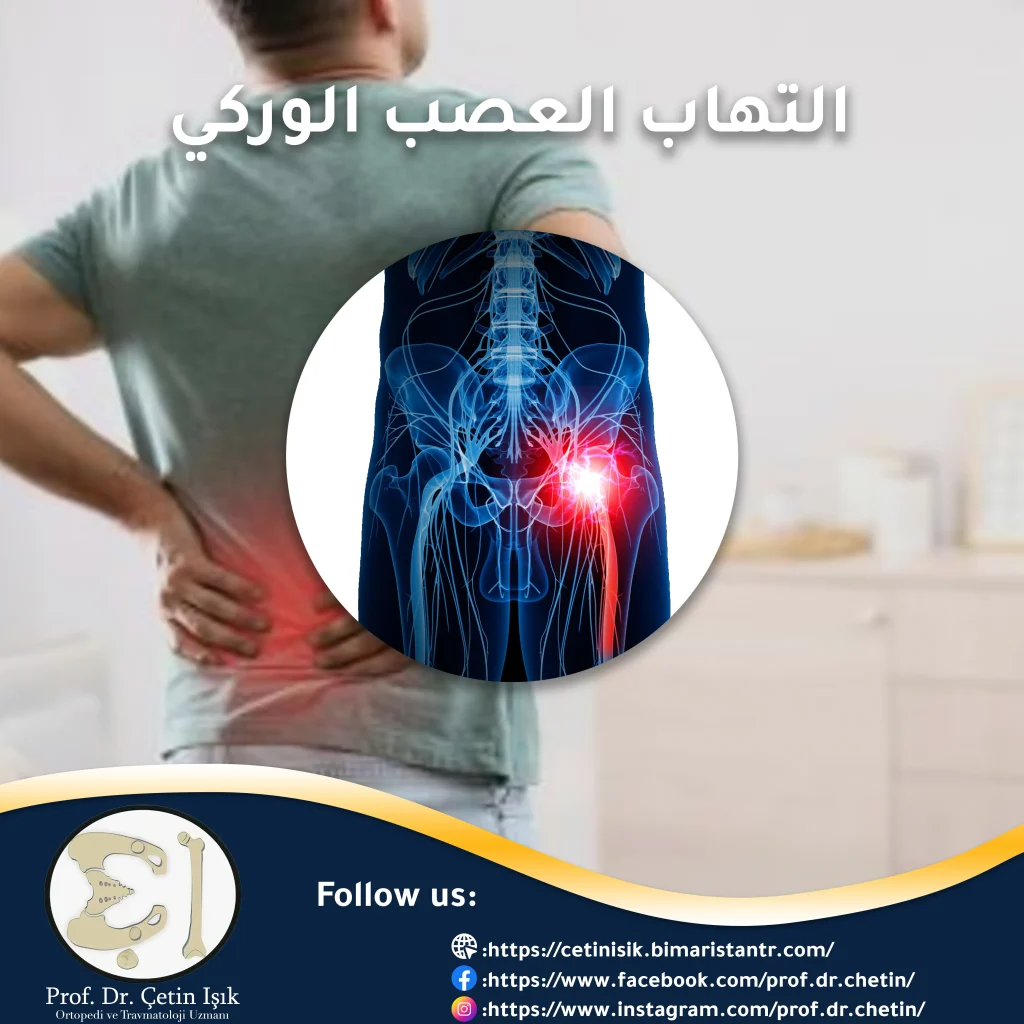 Inflammation of the sciatic nerve (sciatica) and its risks