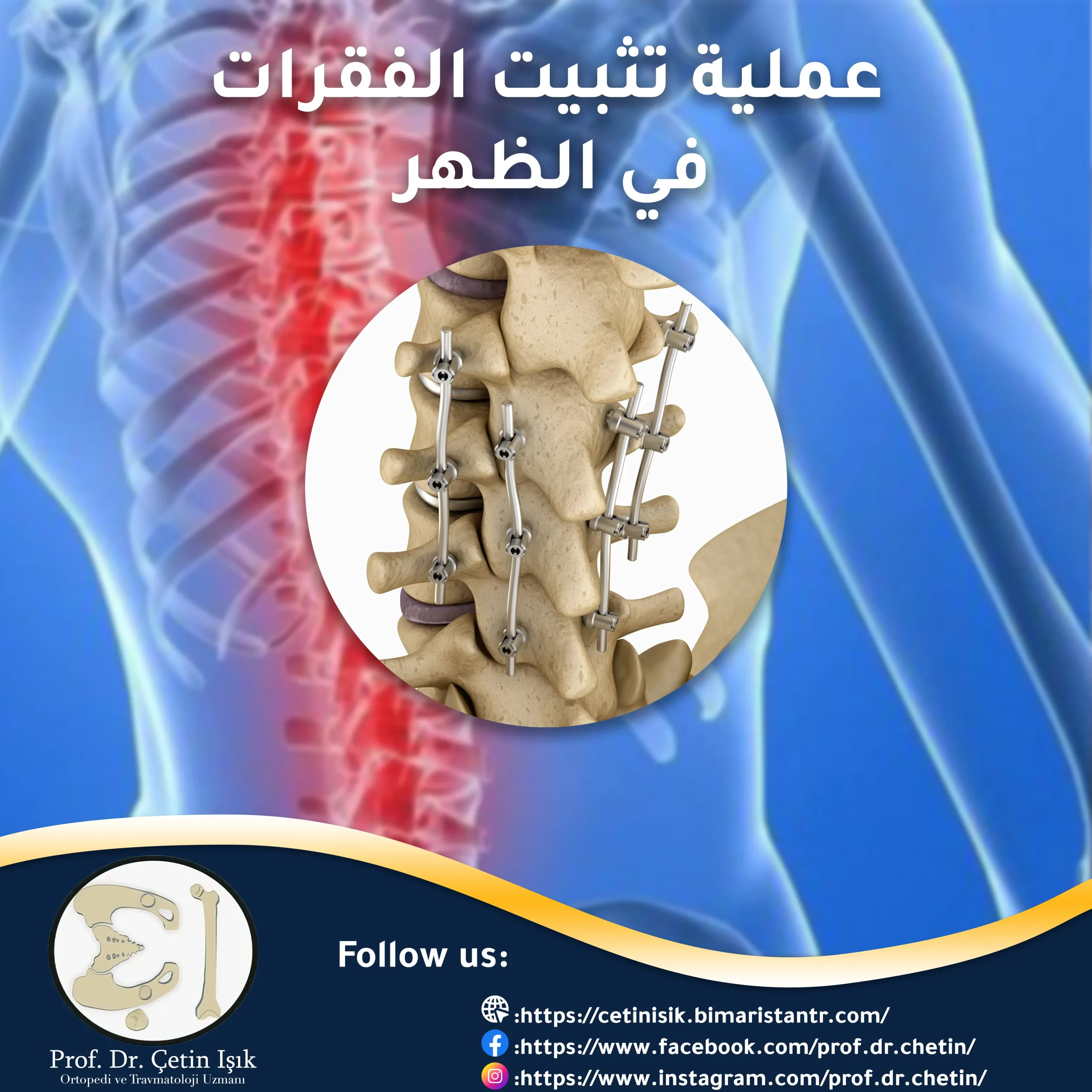 عملية تثبيت الفقرات في الظهر وكل ما يتعلق بها