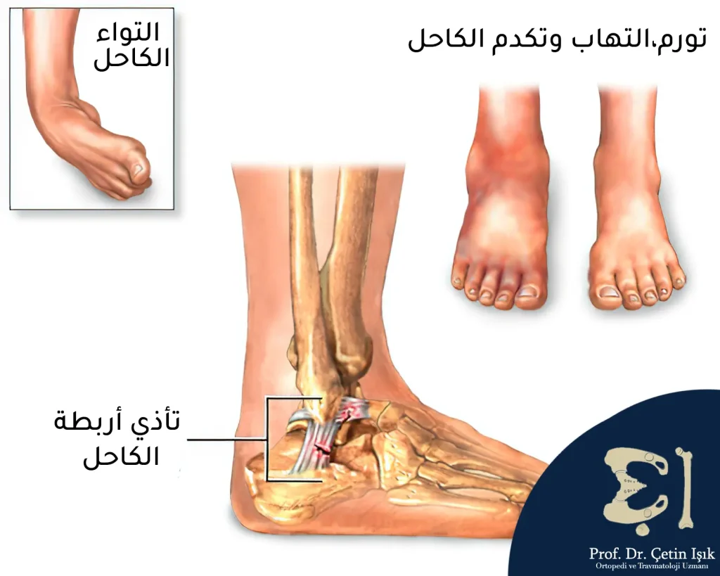 Swelling, inflammation and bruising as a result of ankle sprains and ligament damage