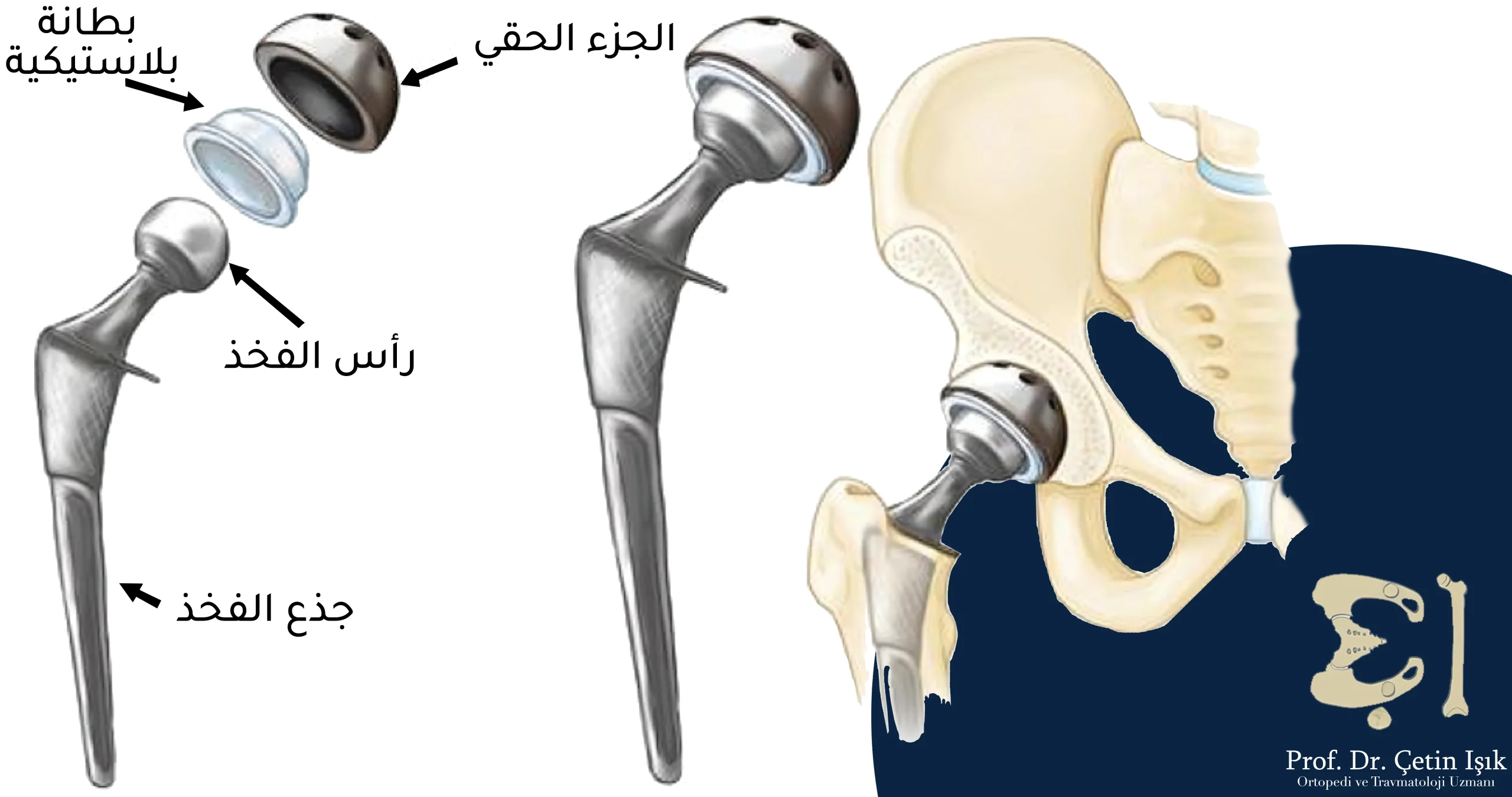 مكونات مفصل الورك الصناعي، حيث يتألف من الجزء الحقي الذي يوضع مكان الجوف الحقي، ورأس الفخذ الصناعي وبينهما بطانة بلاستكية، بالإضافة إلى جذع الفخذ الذي يوضع داخل عظم الفخذ