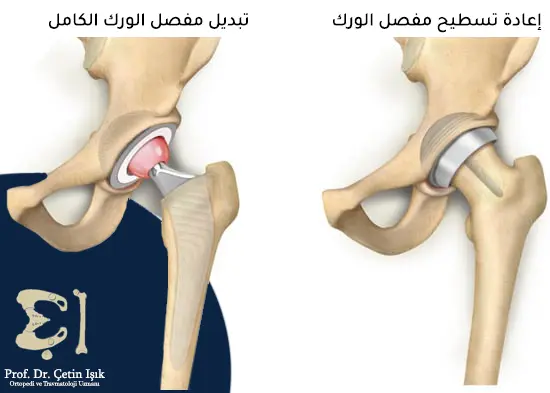 الفرق بين إعادة تسطيح الورك الذي يتم فيه تشذيب رأس الفخذ وتغطيته بغطاء معدني أملس، وتبديل مفصل الورك الكامل الذي يحدث فيه استبدال الرأس والجوف