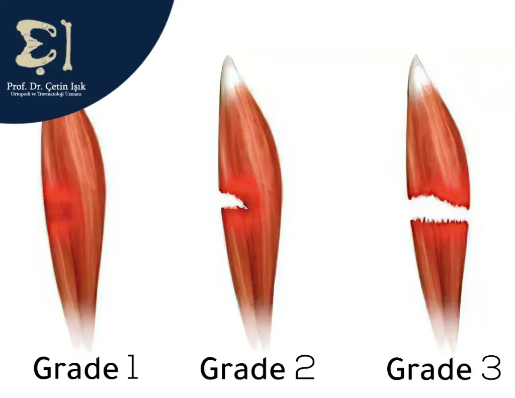The grades of back muscle tears are grade 1 (minor tear), grade 2 (partial tear), and grade 3 (complete tear).